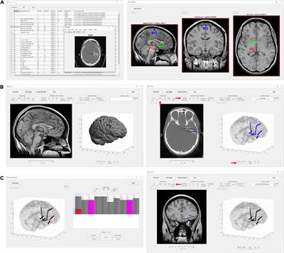 LeGUI: A Fast and Accurate Graphical User Interface for Automated Detection and Anatomical Localization of Intracranial Electrodes